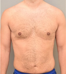 Liposuction After Photo by Keshav Magge, MD; Bethesda, MD - Case 32226