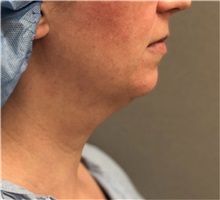 Liposuction Before Photo by Keshav Magge, MD; Bethesda, MD - Case 37074
