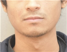 Chin Augmentation Before Photo by Keshav Magge, MD; Bethesda, MD - Case 37519 Chin Augmentation Before Photo by Keshav Magge, MD; Bethesda, MD - Case 37519