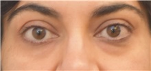 Eyelid Surgery Before Photo by Keshav Magge, MD; Bethesda, MD - Case 37687
