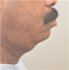 Chin Augmentation Before Photo by Keshav Magge, MD; Bethesda, MD - Case 39639 Chin Augmentation Before Photo by Keshav Magge, MD; Bethesda, MD - Case 39639