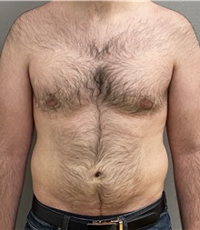 Liposuction After Photo by Keshav Magge, MD; Bethesda, MD - Case 44705