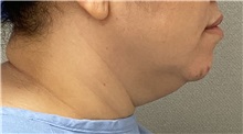 Liposuction Before Photo by Keshav Magge, MD; Bethesda, MD - Case 49548