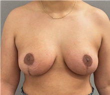 Breast Lift After Photo by Keshav Magge, MD; Bethesda, MD - Case 49761 Breast Lift After Photo by Keshav Magge, MD; Bethesda, MD - Case 49761