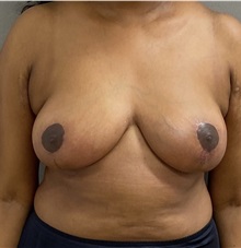Breast Reduction After Photo by Keshav Magge, MD; Bethesda, MD - Case 49760 Breast Reduction After Photo by Keshav Magge, MD; Bethesda, MD - Case 49760