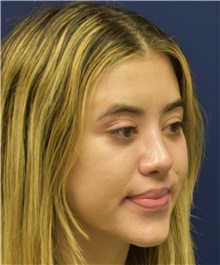 Rhinoplasty After Photo by Richard Reish, MD, FACS; New York, NY - Case 43479
