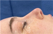 Rhinoplasty Before Photo by Mark Markarian, MD, MSPH, FACS; Wellesley, MA - Case 48533