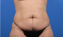 Tummy Tuck Before Photo by C. Bob Basu, MD, MBA, MPH, FACS; Houston, TX - Case 34706 Tummy Tuck Before Photo by C. Bob Basu, MD, MBA, MPH, FACS; Houston, TX - Case 34706