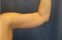 Arm Lift After Photo by C. Bob Basu, MD, MBA, MPH, FACS; Houston, TX - Case 34711 Arm Lift After Photo by C. Bob Basu, MD, MBA, MPH, FACS; Houston, TX - Case 34711