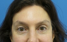Eyelid Surgery After Photo by Michael Epstein, MD, FACS; Northbrook, IL - Case 42218