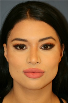 Rhinoplasty After Photo by Steve Laverson, MD, FACS; Rancho Santa Fe, CA - Case 40400