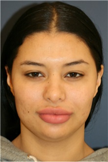 Rhinoplasty Before Photo by Steve Laverson, MD, FACS; Rancho Santa Fe, CA - Case 40400
