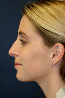 Rhinoplasty Before Photo by Steve Laverson, MD, FACS; Rancho Santa Fe, CA - Case 42448