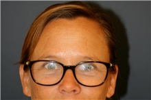 Brow Lift Before Photo by Steve Laverson, MD, FACS; Rancho Santa Fe, CA - Case 44984