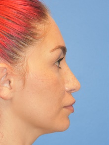 Rhinoplasty After Photo by Adam Weinfeld, MD; Austin, TX - Case 44633